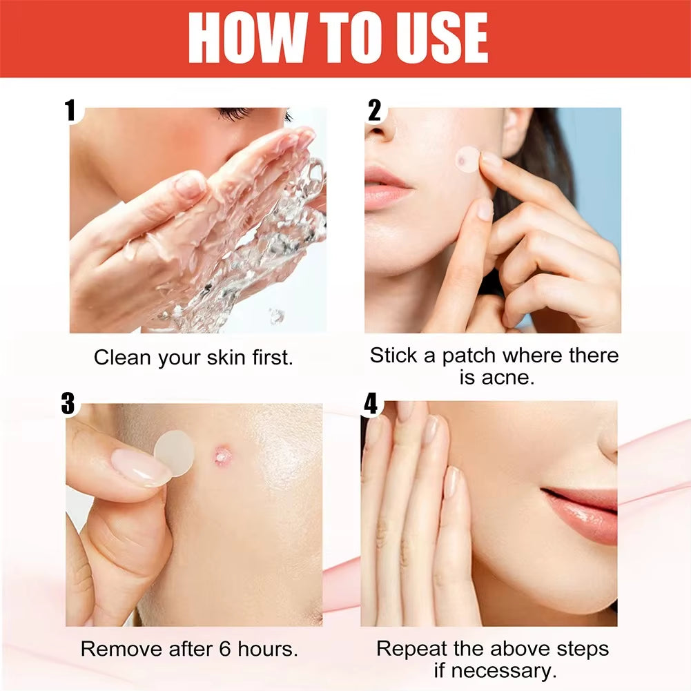 Invisible Hydrocolloid Acne Patches – Fast-Healing, Anti-Inflammatory Spot Treatment