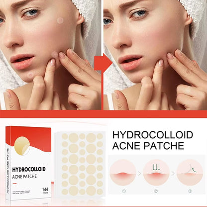 Invisible Hydrocolloid Acne Patches – Fast-Healing, Anti-Inflammatory Spot Treatment