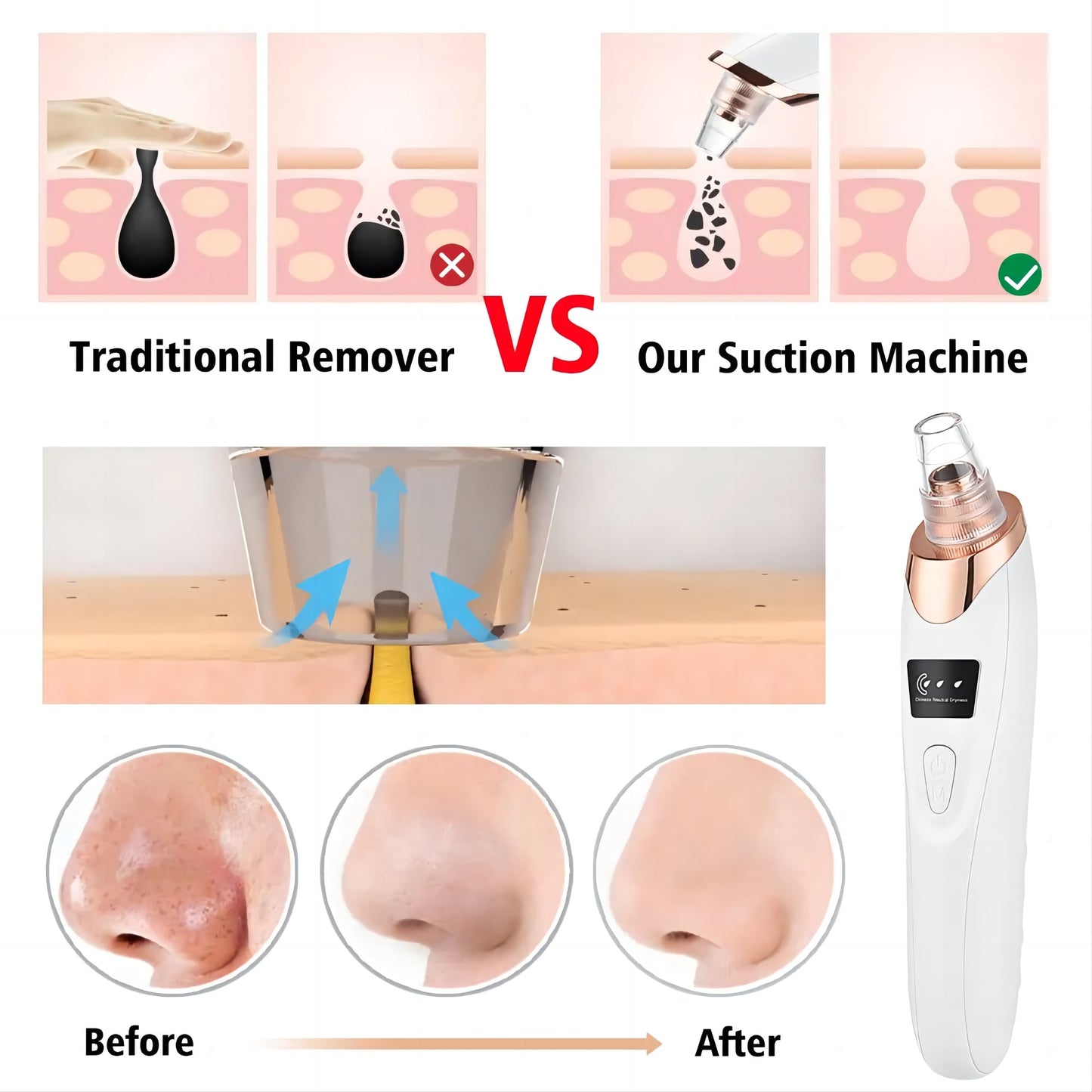 Electric Blackhead Remover Vacuum – Facial & Nose Pore Cleaner for Acne & Blackhead Extraction